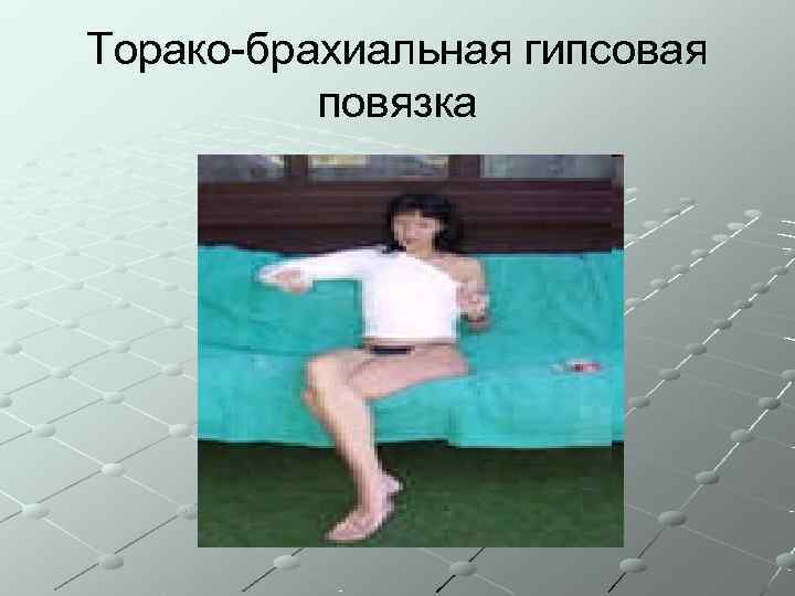 Торако-брахиальная гипсовая  повязка 