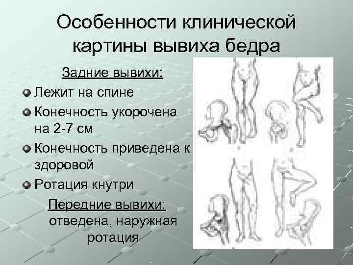   Особенности клинической картины вывиха бедра Задние вывихи: Лежит на спине Конечность укорочена