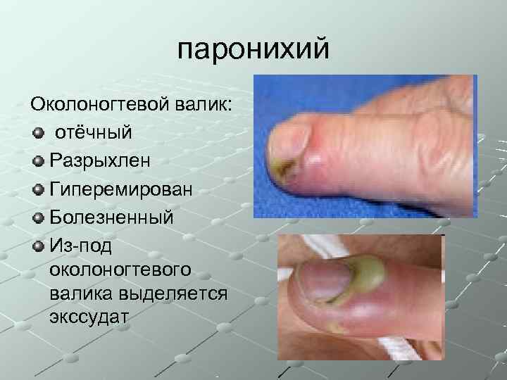    паронихий Околоногтевой валик:  отёчный Разрыхлен Гиперемирован Болезненный Из-под околоногтевого валика