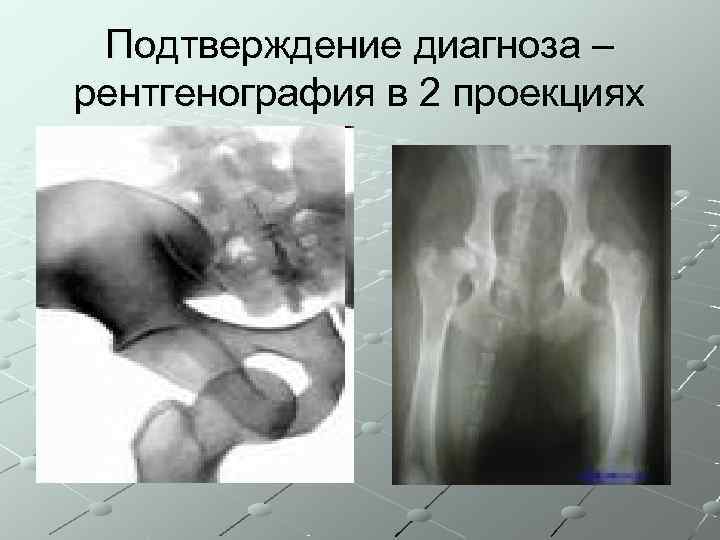  Подтверждение диагноза – рентгенография в 2 проекциях 