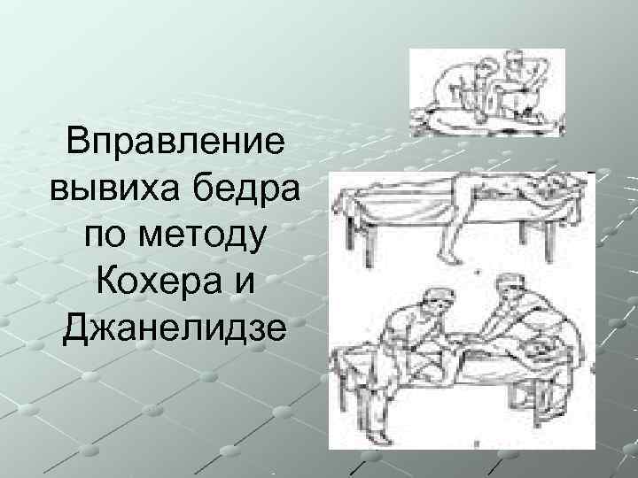  Вправление вывиха бедра  по методу  Кохера и Джанелидзе 