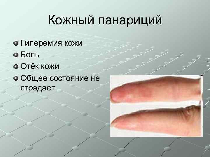  Кожный панариций Гиперемия кожи Боль Отёк кожи Общее состояние не страдает 