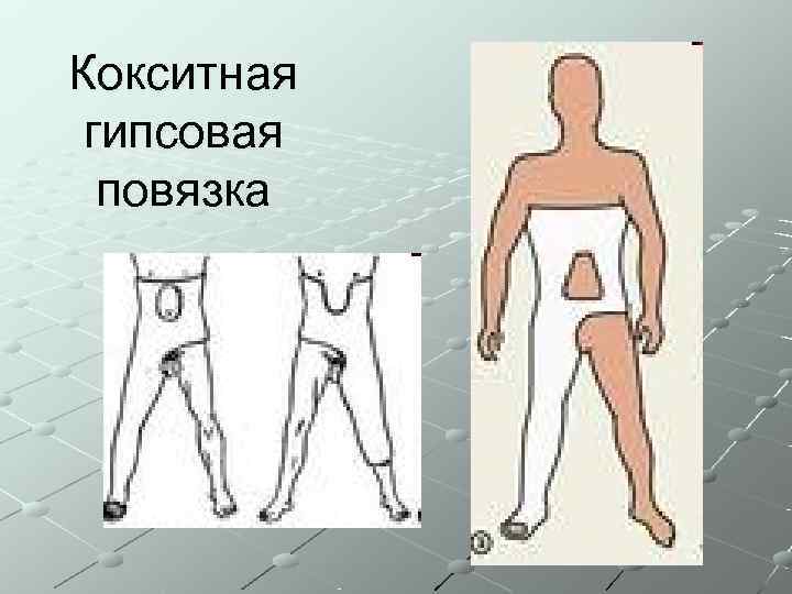Кокситная гипсовая  повязка 