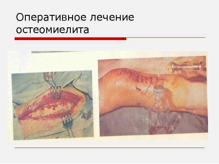 Оперативное лечение остеомиелита 