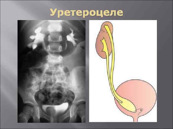 Уретроцеле у женщин фото