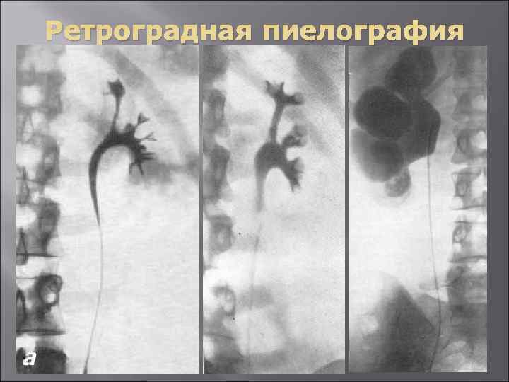 Ретроградная пиелография 