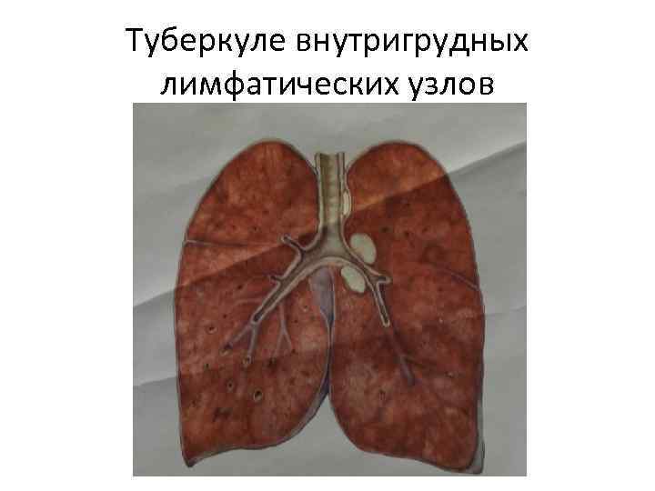 Туберкуле внутригрудных  лимфатических узлов 