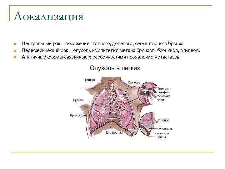 Локализация n Центральный рак – поражение главного, долевого, сегментарного бронха n Переферический рак –