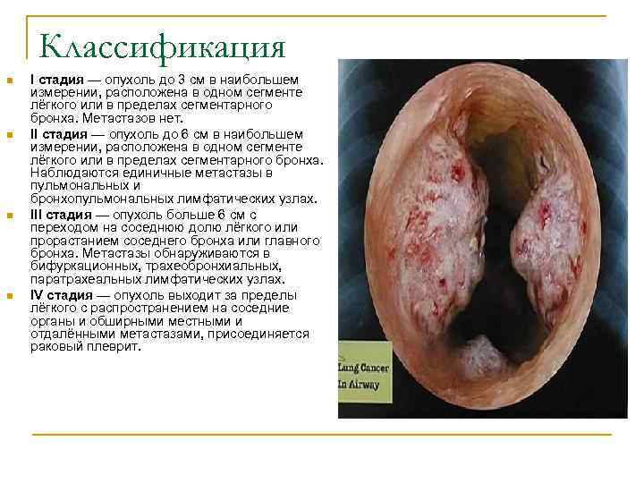  Классификация n I стадия — опухоль до 3 см в наибольшем измерении, расположена