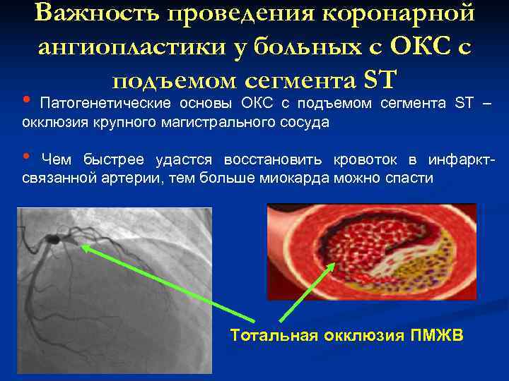  Важность проведения коронарной ангиопластики у больных с ОКС с подъемом сегмента ST •