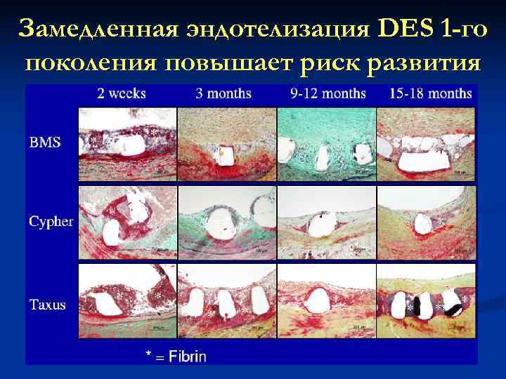 Замедленная эндотелизация DES 1 -го поколения повышает риск развития поздних тромбозов R. Virmani, Euro.