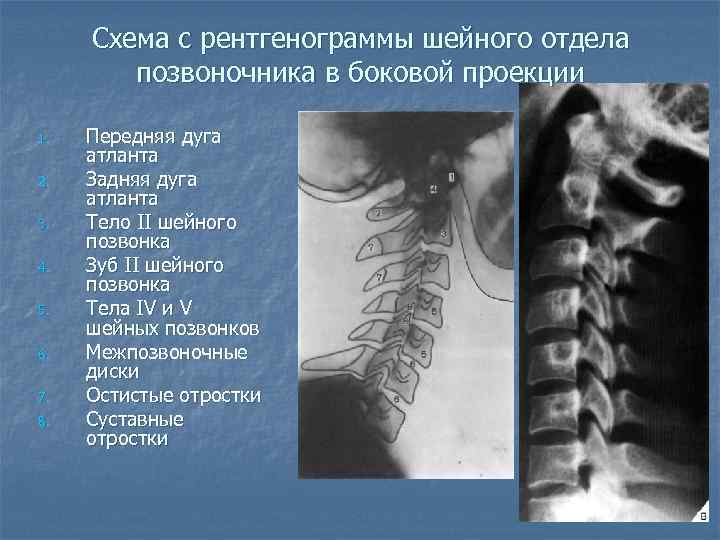  Схема с рентгенограммы шейного отдела   позвоночника в боковой проекции 1. 