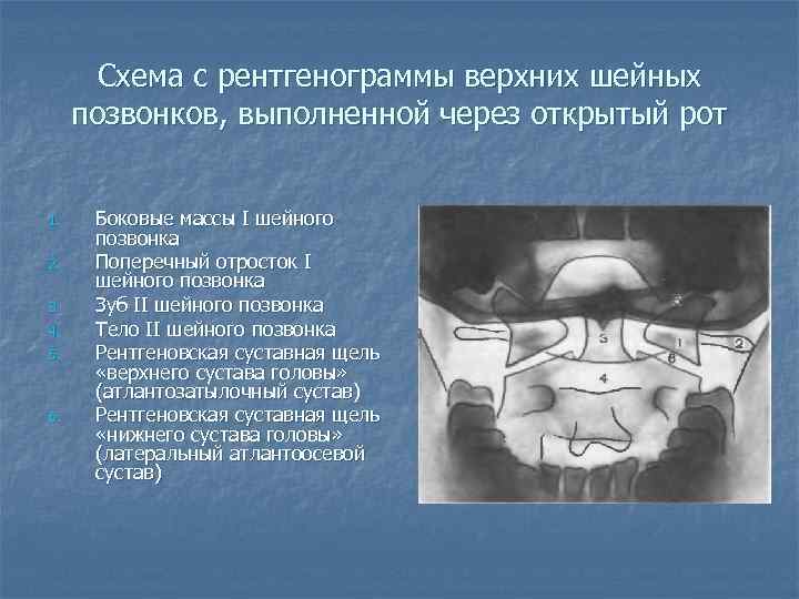   Схема с рентгенограммы верхних шейных позвонков, выполненной через открытый рот  1.