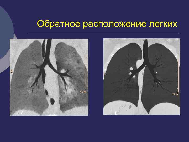 Расположение легких у человека фото