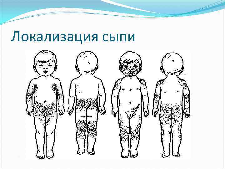 Локализация сыпи 
