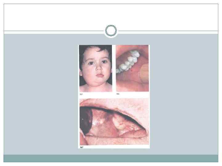    Симптомы  симптом Хетчкока (Hatchcock) - болезненность при надавливании в области