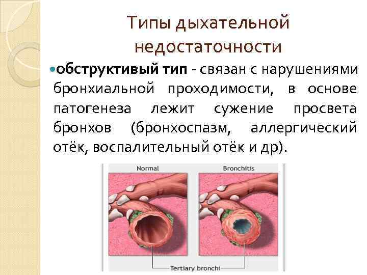    Типы дыхательной    недостаточности рестриктивный тип  - 