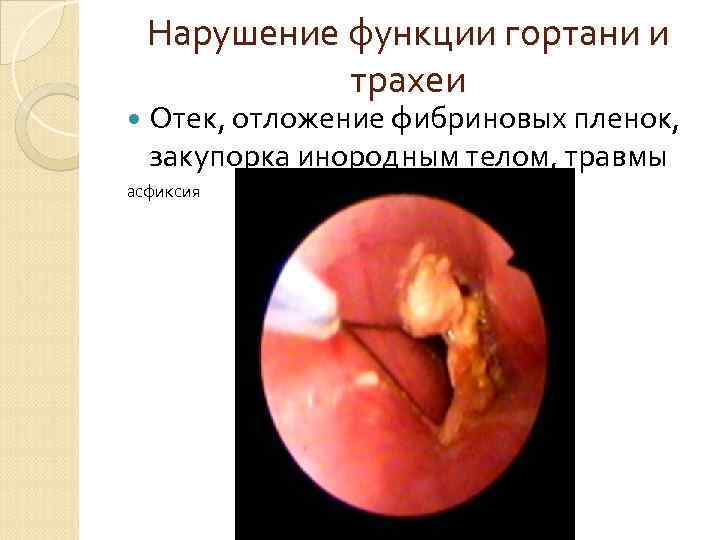 Нарушение функции плевры Скопление экссудата, воздуха, крови в плевральной полости, что затрудняет расправлению легкого