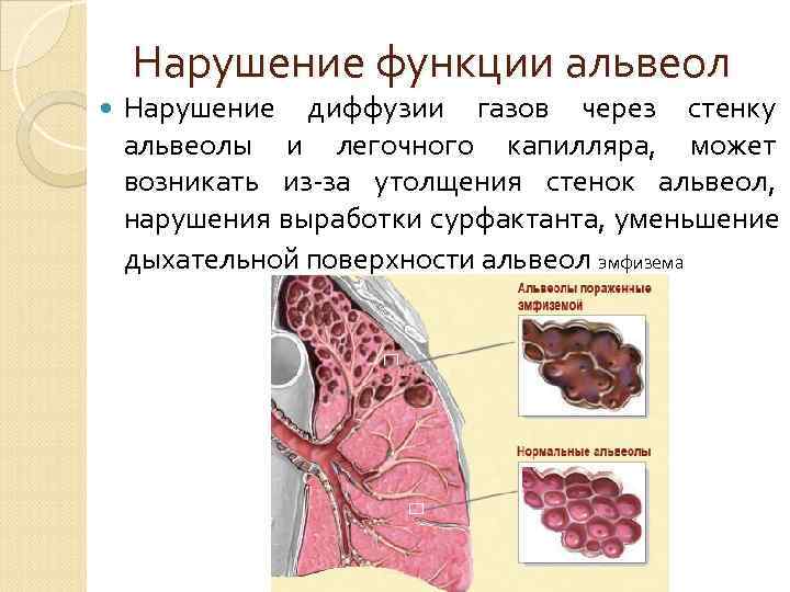   Нарушение функции  дыхательных мышц Наблюдается при поражении самих мышц, нарушении иннервации,