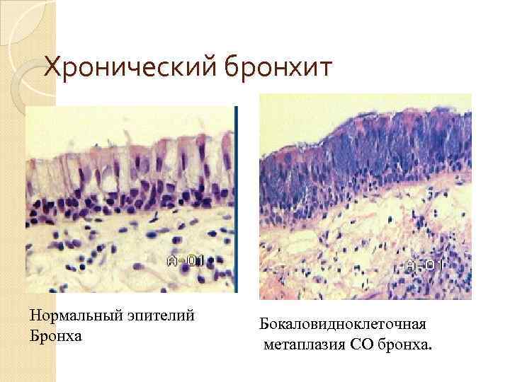   Пневмонии — группа различных по этиологии, патогенезу и морфологической характеристике острых инфекционных