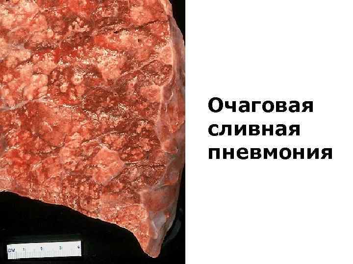 Фагоцитоз нейтрофильными лейкоцитами грамположительных кокков (окраска по Граму) 