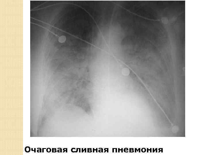 Колонии стафилококков 