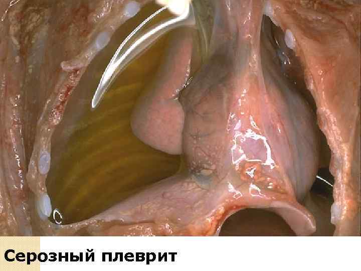 Вазодилятация межальвеолярных перегородок, серозно-фибринозно-гнойный экссудат 