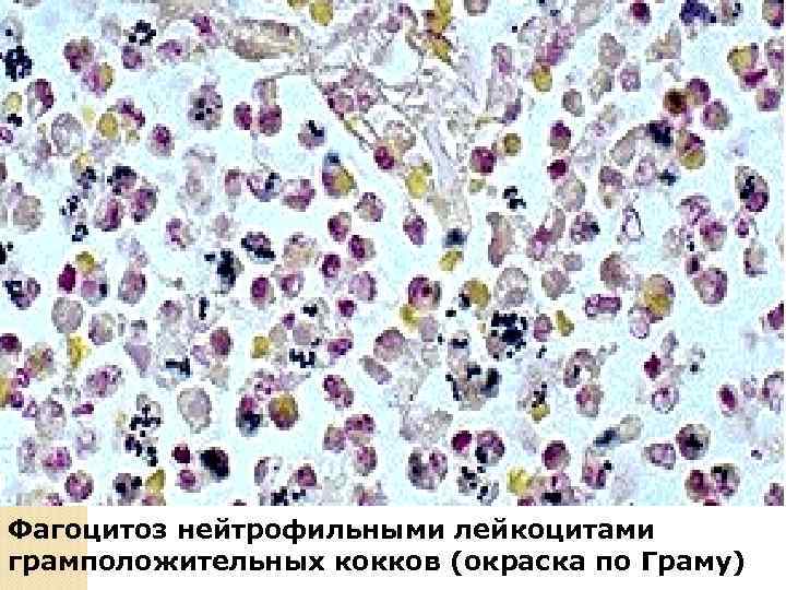 Бронхопневмония 