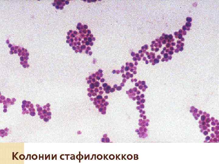   ДОЛЕВЫЕ ПНЕВМОНИИ  Крупозная пневмония (возбудитель —  пневмококк или Streptococcus pneumoniae)
