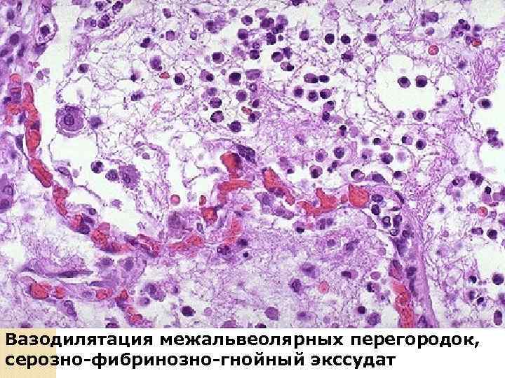 КРУПОЗНАЯ ПНЕВМОНИЯ – острое воспаление легких с долевым поражением и типичной стадийностью, составляют 5