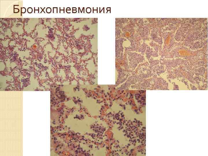  Острое воспаление легких   (пневмония) Крупозная  пневмония  –  острое