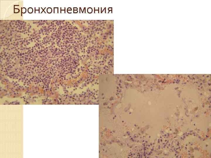Стадии пневмонии  Стадия гиперемии и прилива.  Cтадия красного опеченения.  Стадия серого