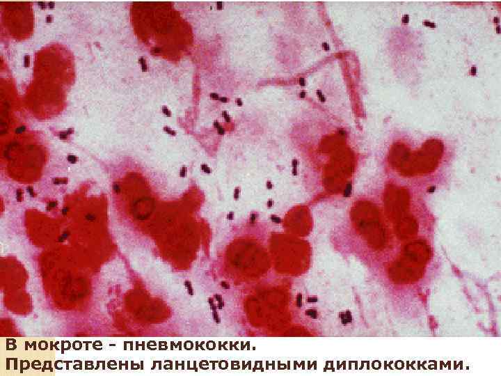 Крупозная пневмония, стадия красного опеченения 
