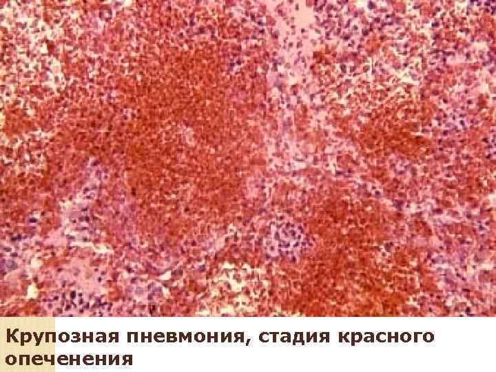 Долевая пневмония 