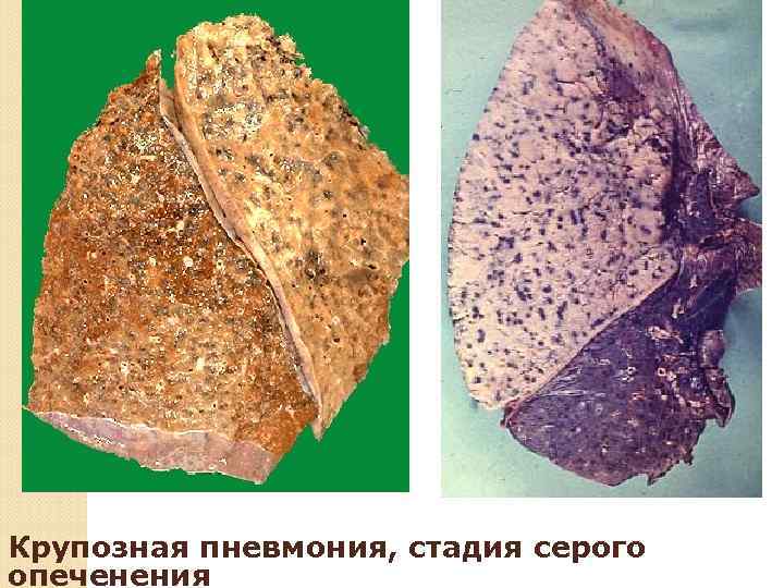 СТАДИЯ РАЗРЕШЕНИЯ Одиннадцатые – двенадцатые сутки болезни.  Фибринозный экссудат подвергается расплавлению и фагоцитозу