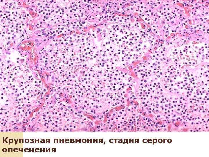 Острый фибринозно- гнойный плеврит при крупозной пневмонии 