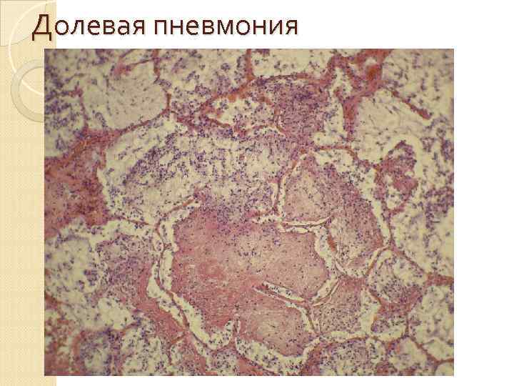 Абсцедирующая стафилококковая пневмония 