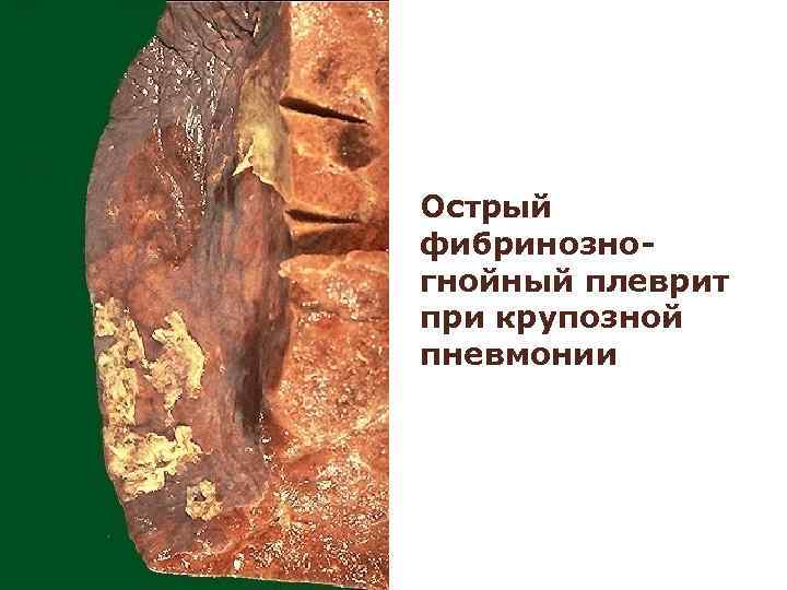 Абсцедирующая пневмония 