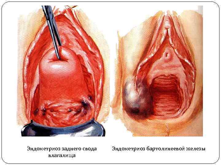 Эндометриоз заднего свода  Эндометриоз бартолинеевой железы  влагалища 