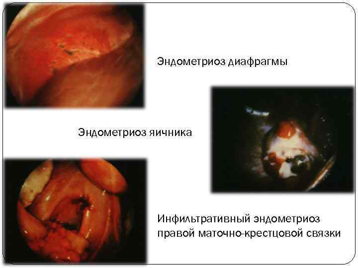    Эндометриоз диафрагмы Эндометриоз яичника   Инфильтративный эндометриоз   правой