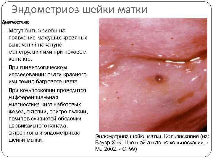   Эндометриоз шейки матки Диагностика: - Могут быть жалобы на  появление мажущих