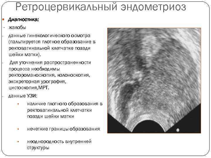   Ретроцервикальный эндометриоз  Диагностика: - жалобы -  данные гинекологического осмотра (пальпируется