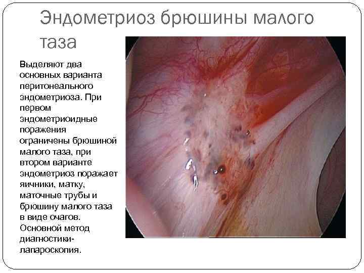   Эндометриоз брюшины малого таза Выделяют два основных варианта перитонеального эндометриоза. При первом