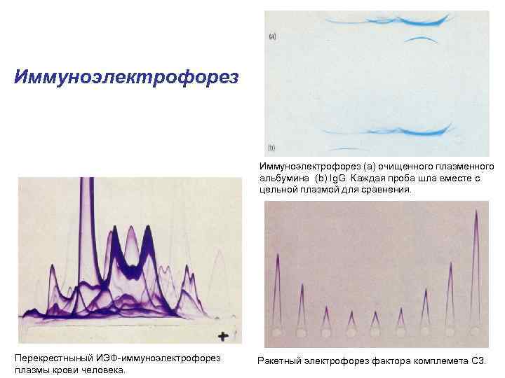 Иммуноэлектрофорез (а) очищенного плазменного альбумина (b) Ig. G. Каждая проба шла вместе с цельной