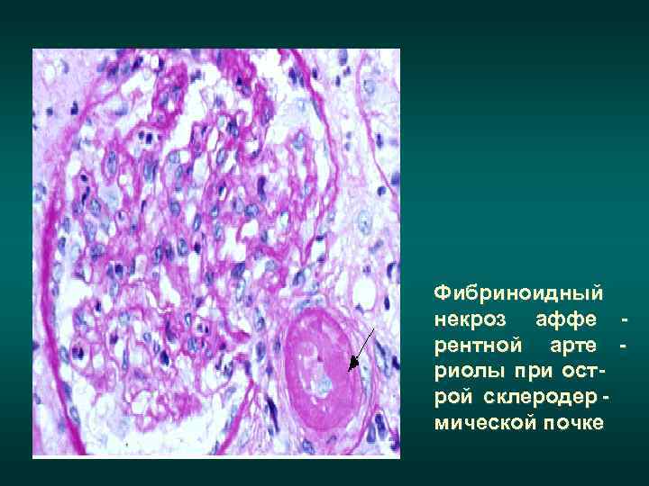15 -летняя выживаемость у больных с  поражением почек составляет 13%  При острой