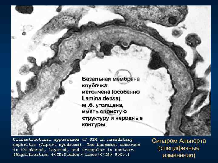  Базальная мембрана клубочка: истончена (особенно Lamina densa), м. б. утолщена, иметь слоистую структуру