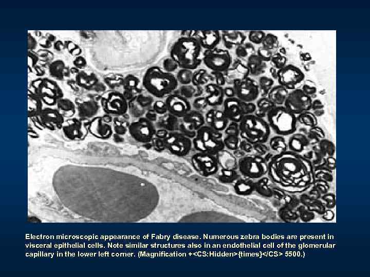 Electron microscopic appearance of Fabry disease. Numerous zebra bodies are present in visceral epithelial