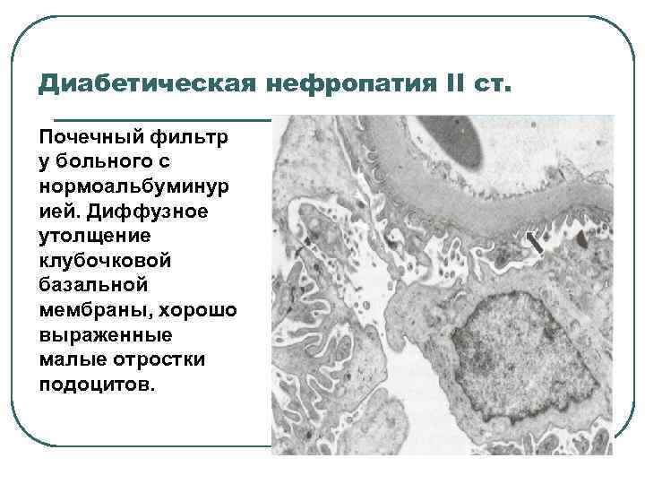 Базальная мембрана почки. Почечный фильтр. Малые отростки подоцитов. Фильтрующая мембрана почки. Строение базальной мембраны почки.