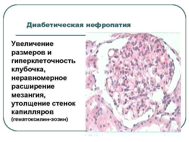 Сахарный диабет патанатомия презентация