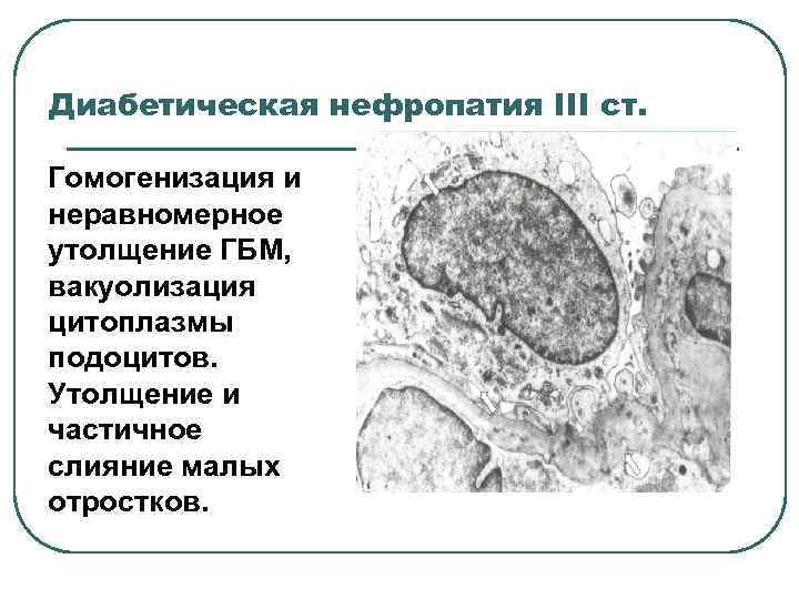 Диабетическая нефропатия III ст.  Гомогенизация и неравномерное утолщение ГБМ,  вакуолизация цитоплазмы подоцитов.